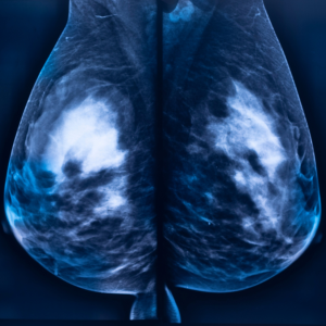 Breast cancer scan